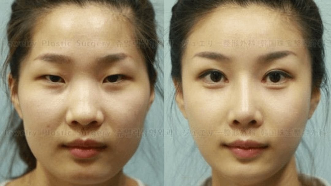 Chinese Women Detained After Plastic Surgery Leaves Them Unrecognizable at Airport